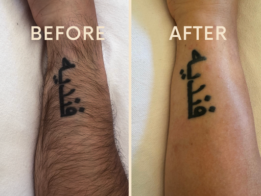 Before and after photos of using Sugar Squared's hair removal